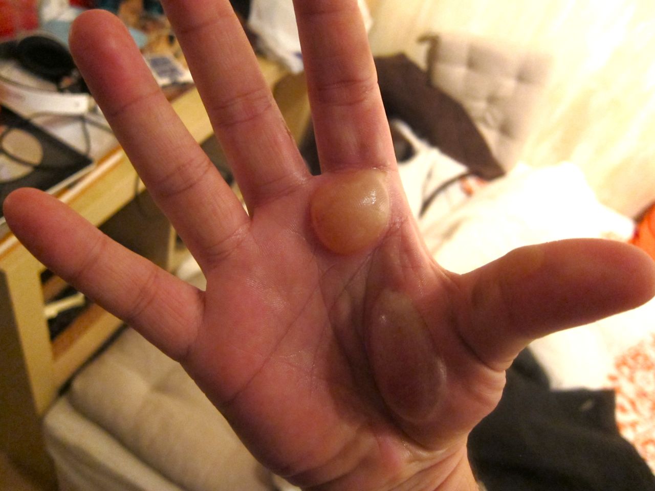 "When I was in school, I got second degree burns on my hand and the blisters on my palm were sickeningly large. Even some of the chefs who'd worked in the industry for 30 plus years screamed or had to walk away when they saw my hand" Reynolds told OutFront. Pictured here is an injury to Reynolds' hand while he was a student at Le Cordon Bleu.