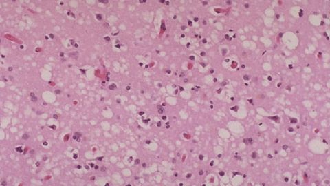 This tissue slide shows sponge-like lesions in the brain tissue of a classic CJD patient. This lesion is typical of many prion diseases.