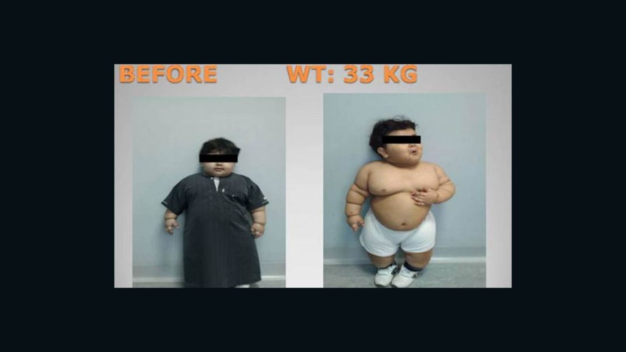 The two-year-old Saudi patient is seen here before bariatric surgery to reduce his weight.