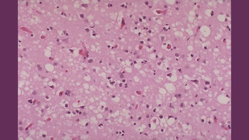 This tissue slide shows sponge-like lesions in the brain tissue of a classic Creutzfeldt-Jakob disease patient. This lesion is typical of many prion diseases. Creutzfeldt-Jakob disease strikes fewer than 400 people a year in the United States, according to the CDC. Victims show signs of memory loss and cognitive difficulty early on; the ailment is "rapidly progressive and always fatal, " the CDC says.
