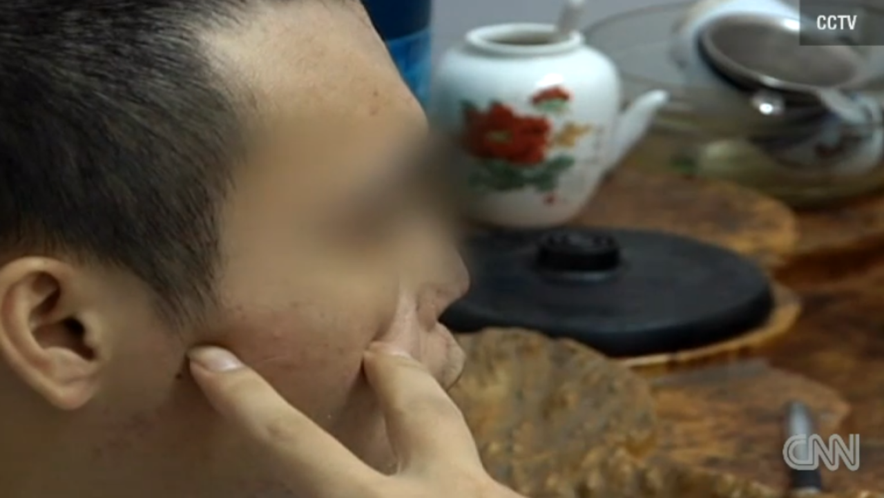 "Xiaolan" sufrió un trauma nasal severo en un accidente de carro en agosto de 2012, de acuerdo con CCTV.