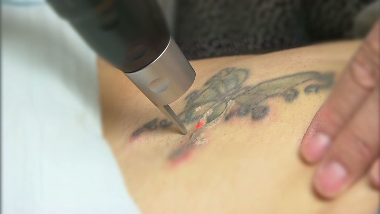 exp hm-tattoo removal_00000501.jpg