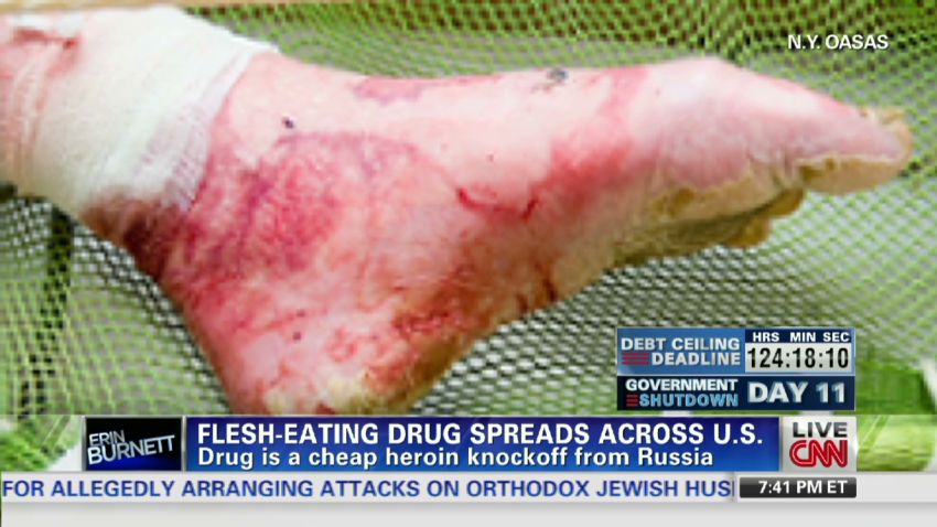 Krokodil: Flesh-eating 'zombie' drug may be in U.S.