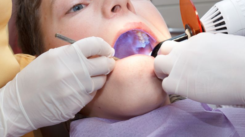 <strong>Dental sealants: </strong>Here's yet another reason to brush your teeth (although, fair warning: <a href="index.php?page=&url=http%3A%2F%2Fwww.atsdr.cdc.gov%2Fsubstances%2Ftoxchemicallisting.asp%3Fsysid%3D41" target="_blank" target="_blank">toothbrushes can contain phthalates</a>). "Dental materials used to treat and prevent cavities can contribute to very low-level BPA exposure for a few hours after placement," according to the <a href="index.php?page=&url=http%3A%2F%2Fwww.ada.org%2F1766.aspx" target="_blank" target="_blank">American Dental Association</a>.