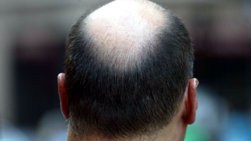 bald man hair loss