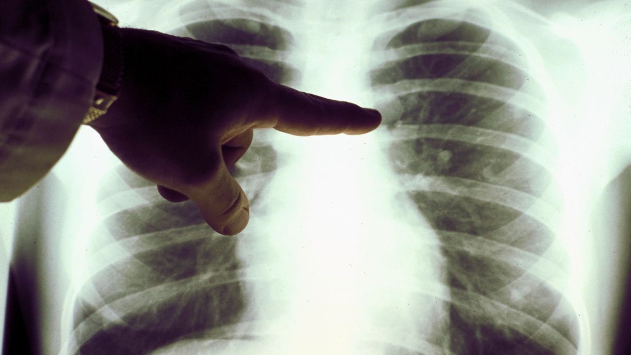 Lung cancer kills roughly twice as many women as breast cancer, and almost three times as many men as prostate cancer. 