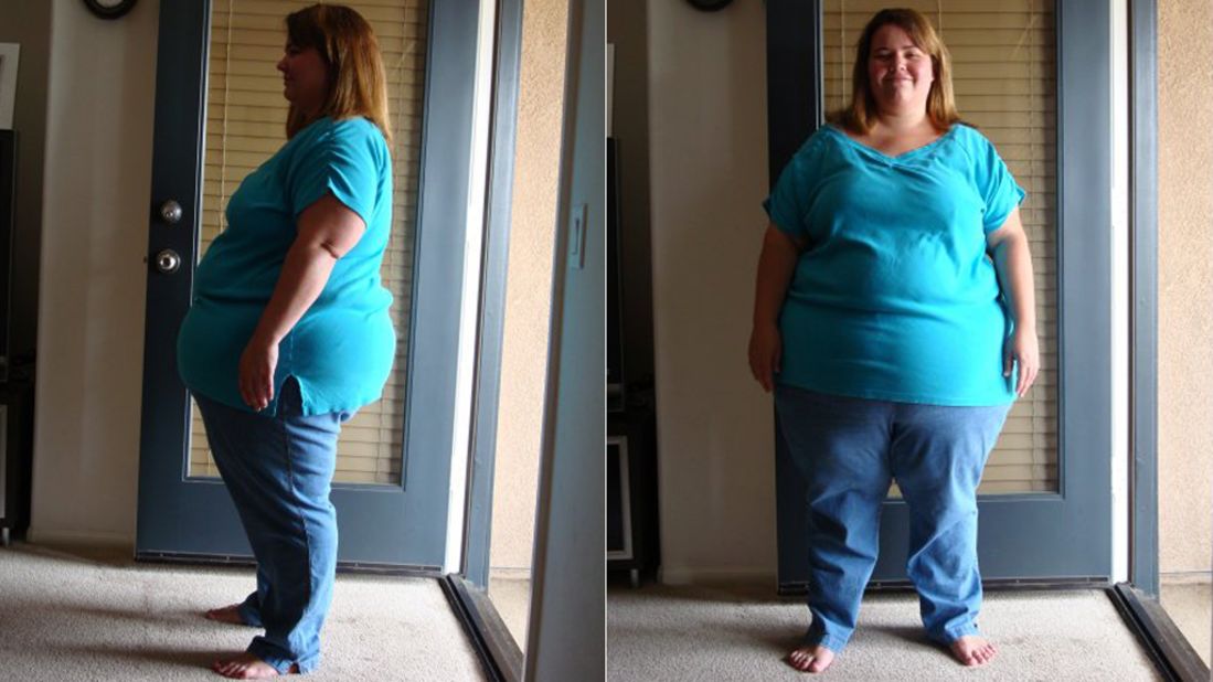 Shack's wife, Amy, carried 322 pounds on her 5-foot-1 frame before getting gastric bypass surgery in summer 2009. 
