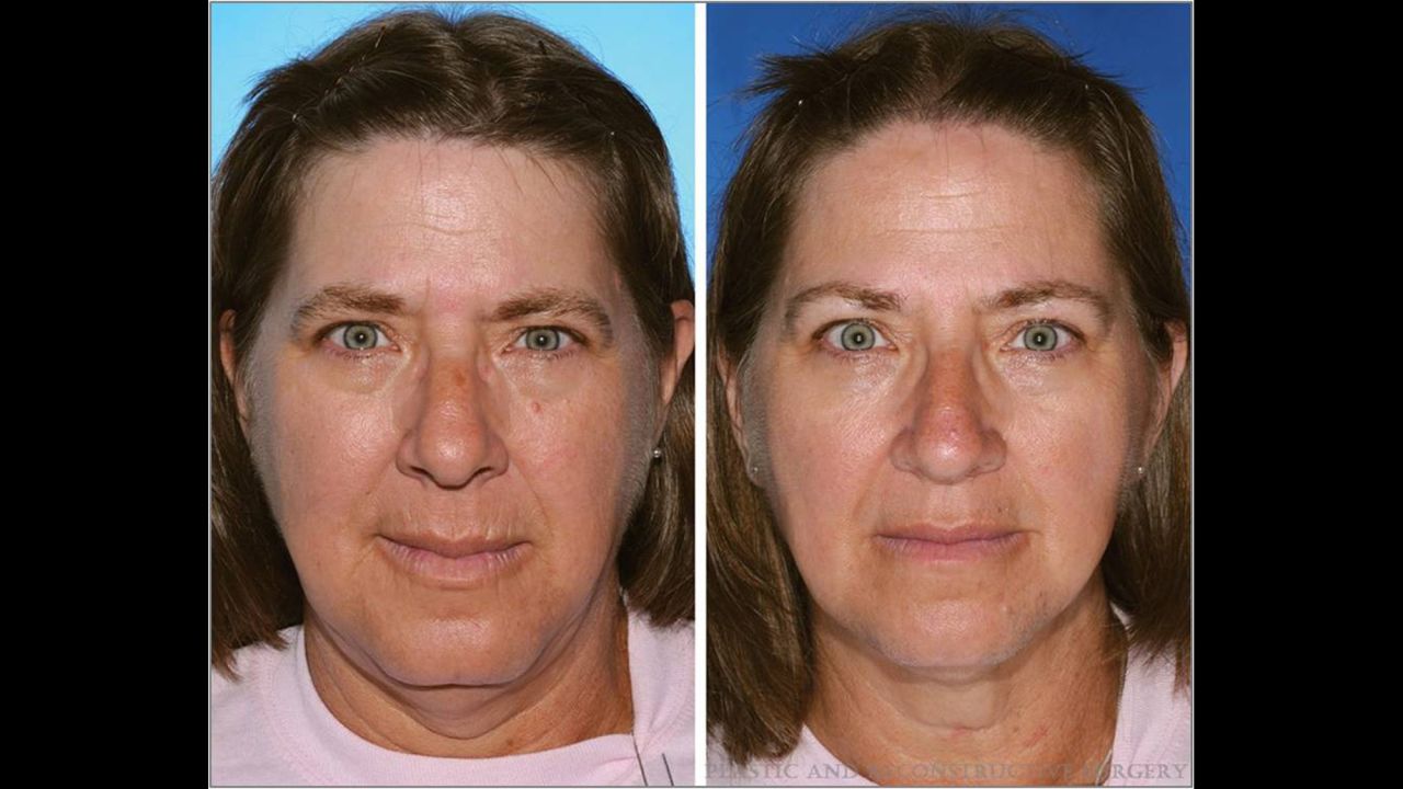 The twin on the left has smoked 17 years longer than the twin on the right. Note the differences in lower lid bags and upper and lower lip wrinkles.