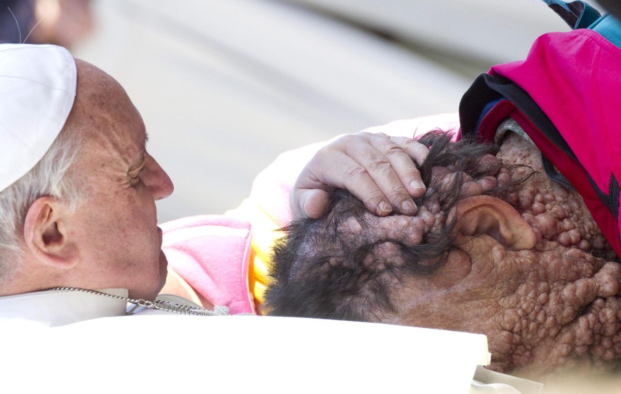 El Papa abraza a un hombre desfigurado. El Papa Francisco acaricia a un hombre que sufre de una rara enfermedad, el miércoles, 6 de noviembre, en la Plaza de San Pedro.