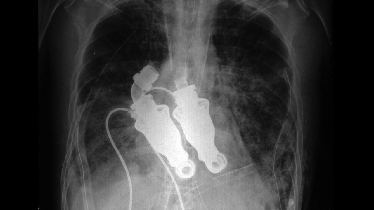 In March 2011, the doctors inserted the double LVAD into a human patient: 55-year-old Craig Lewis who was diagnosed with a rare autoimmune disease. Lewis survived for six weeks on the device.
