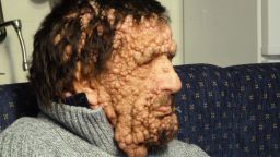 Vinicio Riva suffers from a non-infectious genetic disease, neurofibromatosis type 1. It has left him completely covered, from head to toe, with growths, swellings and itchy sores. His mother suffered from the same illness before she died, and his sister has a milder version of it.