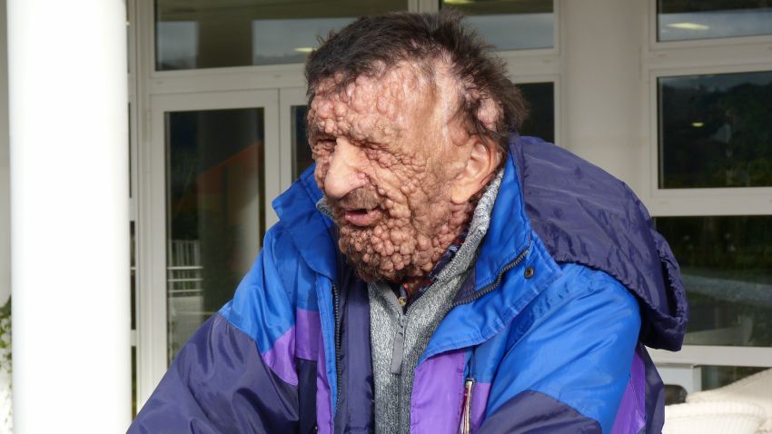 Vinicio Riva suffers from a non-infectious genetic disease, neurofibromatosis type 1. It has left him completely covered, from head to toe, with growths, swellings and itchy sores. His mother suffered from the same illness before she died, and his sister has a milder version of it.
