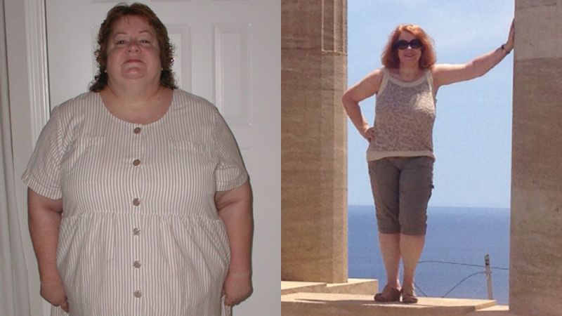 gastric sleeve 10 years later gastric sleeve 10 years later