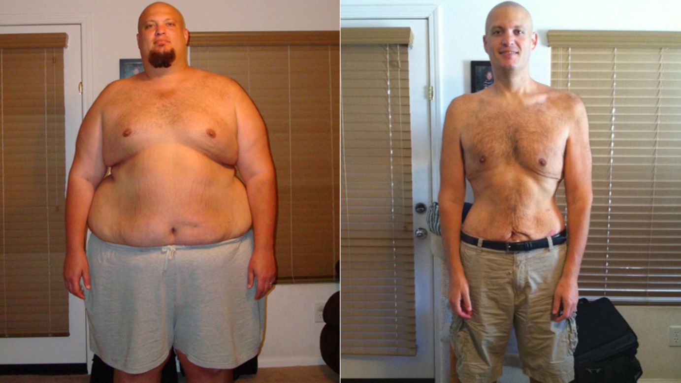Matthew Shack dropped 265 pounds with ease -- moving more and eating less. But <a href="http://www.cnn.com/2013/11/04/health/weight-loss-matthew-shack/index.html">keeping the weight off</a> has proven more difficult. 