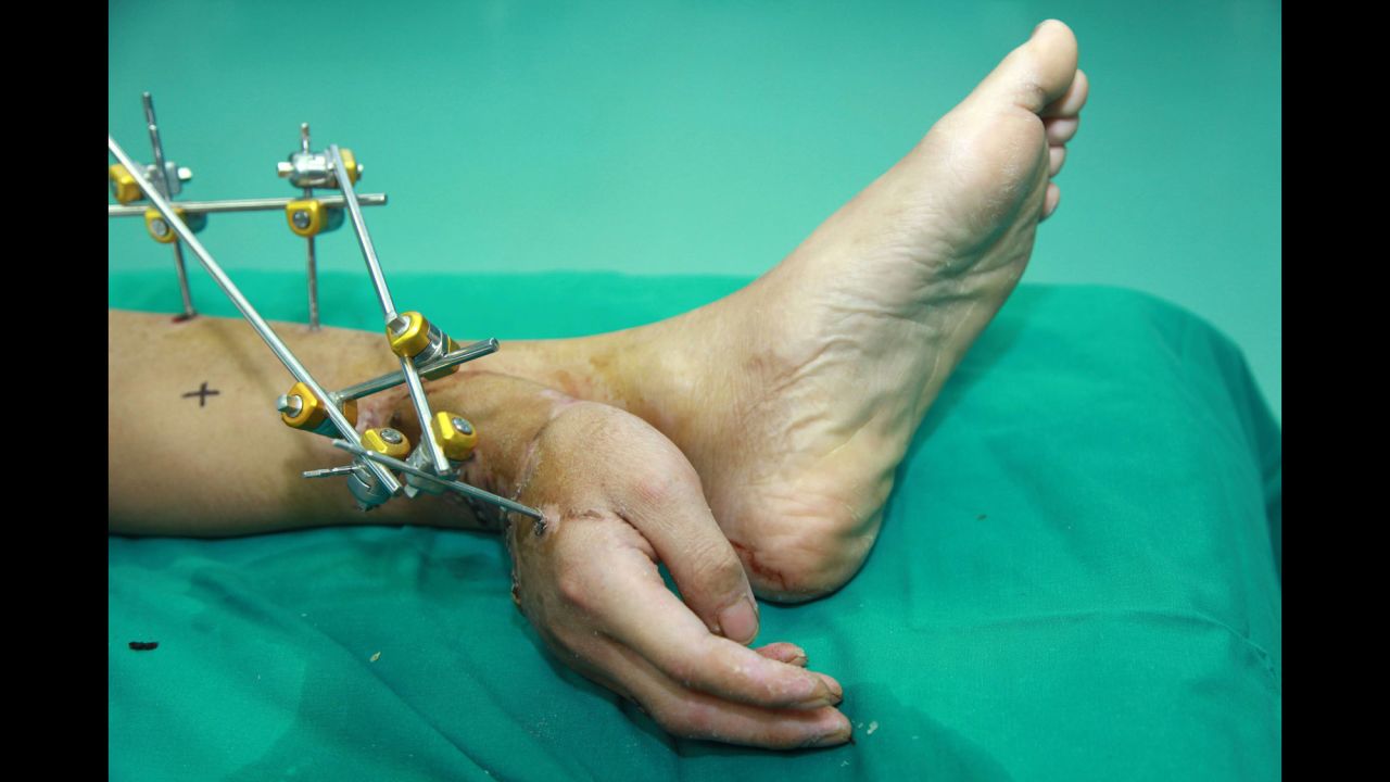 <strong>December 4:</strong> Xiao Wei lies on a hospital bed in Changsha, China, with his hand grafted to his ankle. Wei lost his right hand in a work accident and doctors were able to save it by temporarily grafting it to his ankle, local media reported. The hand was later reattached to his arm after the arm healed enough for surgery.
