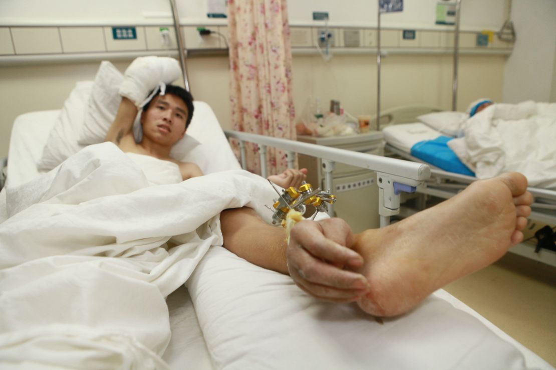Doctors grafted Xiao Wei's right hand onto his ankle