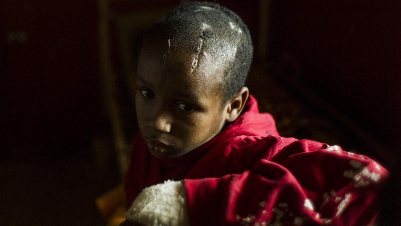 A boy scarred from a machete attack waits at a pediatric hospital in Bangui on Wednesday, December 18.