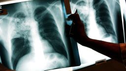 A doctor examines the x-rays of a tuberculosis (TB) patient at a TB clinic November 27, 2002 in Brooklyn, New York. 