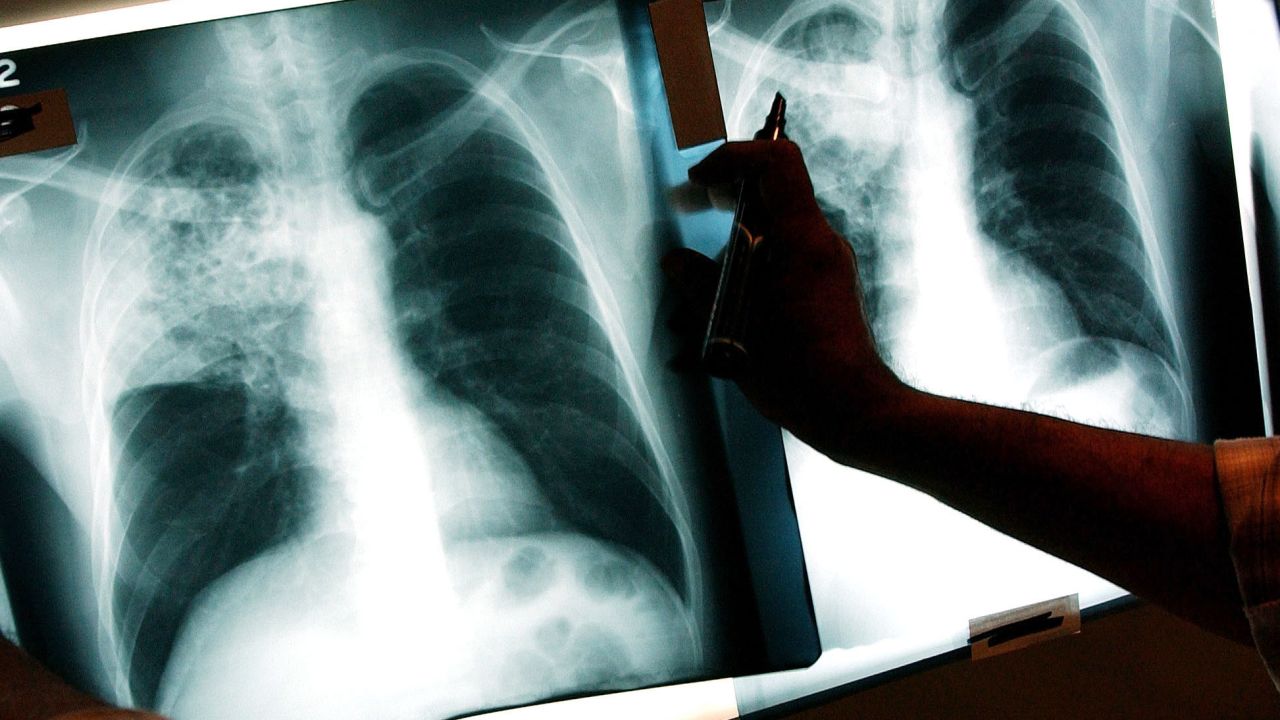  A doctor examines the x-rays of a tuberculosis (TB) patient at a TB clinic Novmeber 27, 2002, in Brooklyn, New York. (Photo by Spencer Platt/Getty Images)
