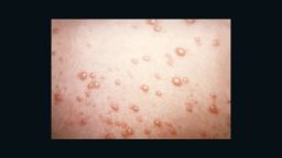 This pustulovesicular rash represents a generalized herpes outbreak due to the Varicella-zoster virus (VZV) pathogen. The VZV pathogen may lay dormant in the spinal nerve roots through a chickenpox infected individual's life, only manifesting its presence through outbreaks as Shingles, or herpes zoster. It is caused by the Herpesviridae chickenpox virus.