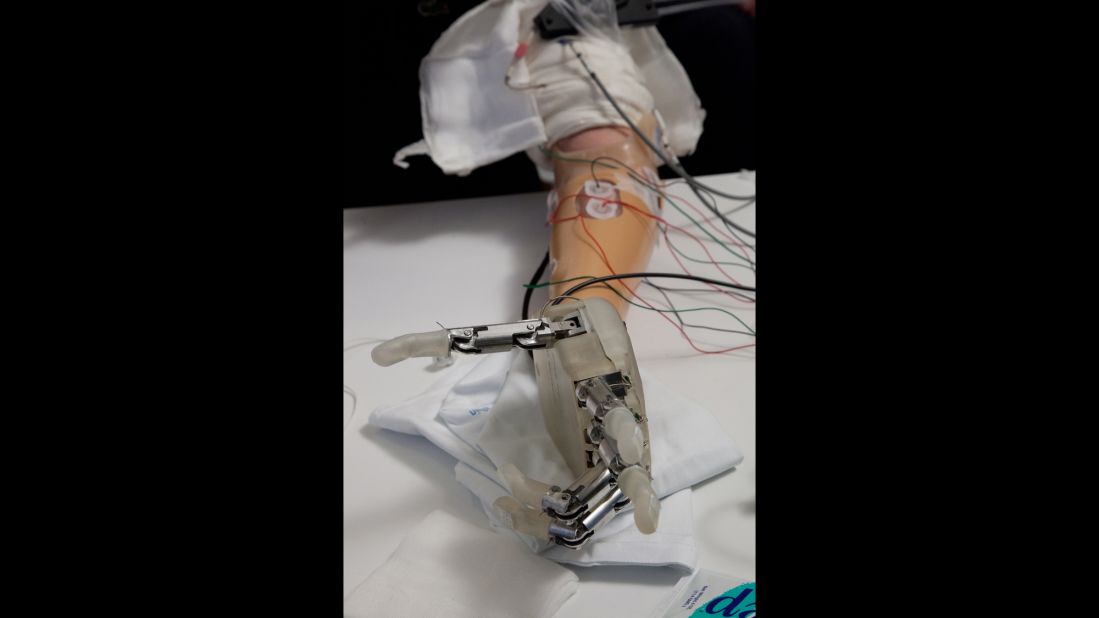 Researchers surgically implanted electrodes in nerves in Sorensen's left arm so that he could use the hand to feel in a natural way. 