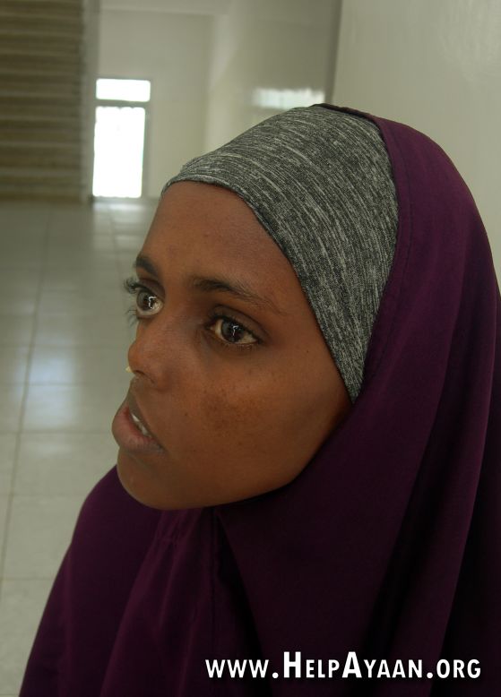 El lado izquierdo del rostro de Ayan Mohamed no fue tocado por la metralla que destrozó el lado derecho durante la guerra civil de Somalia. Ayan es fotografiada aquí sin el niqab que ella usa para evitar miradas y preguntas no deseadas.