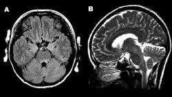 Figure 1. Magnetic resonance images of the brain. A) Hyperintense lesions in the tegmentum of the pons in the axial section of the fluid-attenuated inversion recovery image. B) In the sagittal section of the T2-weighted image, hyperintense lesions are present in the tegmentum of the midbrain, pons, and medulla oblongata.