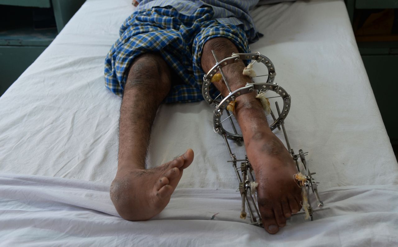 Polio can lead to paralyisis of the arms and legs. An Indian polio patient lies on a bed during treatment in New Delhi, India in January 2014. 