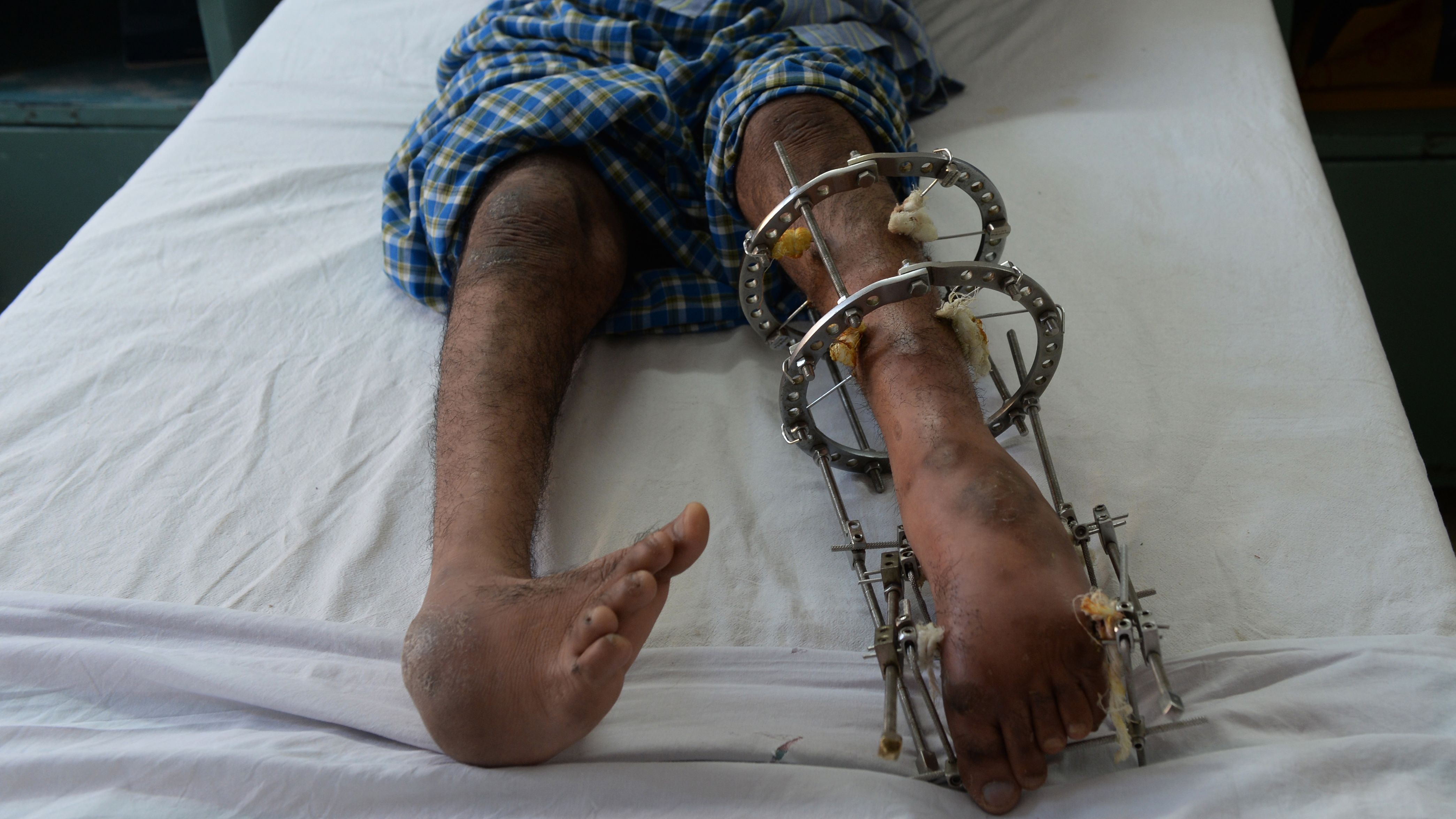 A polio patient lies on a bed during treatment at St. Stephen's Hospital in New Delhi, India. 