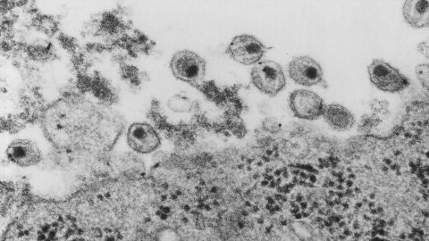 Human immunodeficiency virus as seen through a microscope.