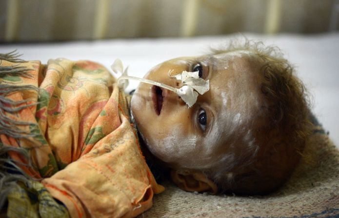 A child affected by famine is treated at a government hospital in Mithi, Pakistan, on Tuesday, March 11.