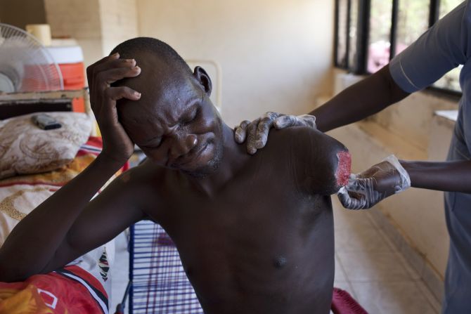 An amputee, injured during recent fighting in South Sudan, is assisted at a hospital in Juba, South Sudan, on Saturday, March 8.