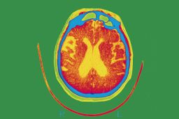 A scan showing the brain of an Alzheimer's patient.