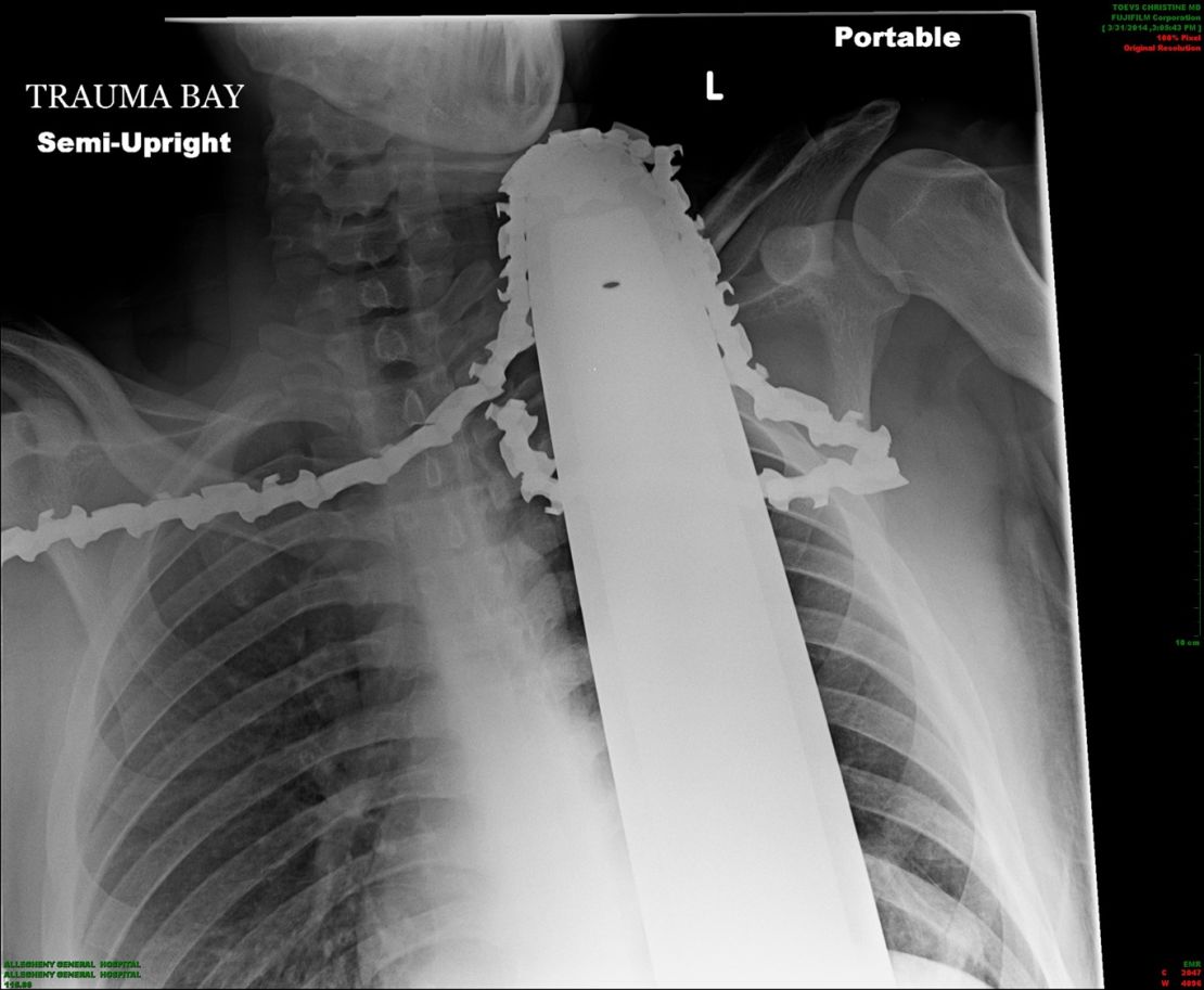  Pennsylvania man James Valentine, 21, cut it close after a chainsaw blade entered his neck missing a vital artery by a mere centimeter, according to a doctor Tuesday. 