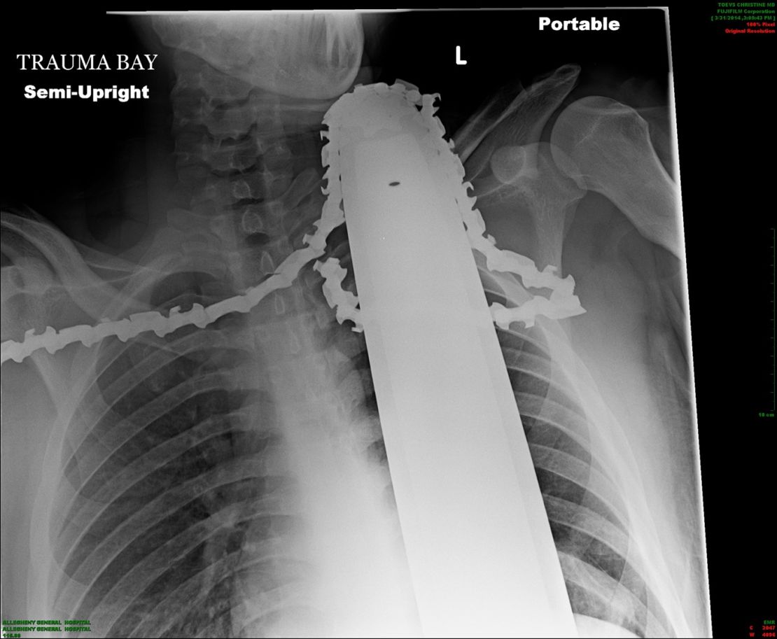 Pennsylvania man James Valentine, 21, cut it close after a chainsaw blade entered his neck missing a vital artery by a mere centimeter, according to a doctor Tuesday.