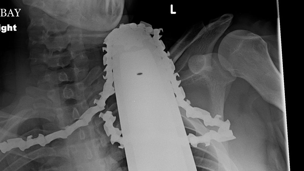  Pennsylvania man James Valentine, 21, cut it close after a chainsaw blade entered his neck missing a vital artery by a mere centimeter, according to a doctor Tuesday. 