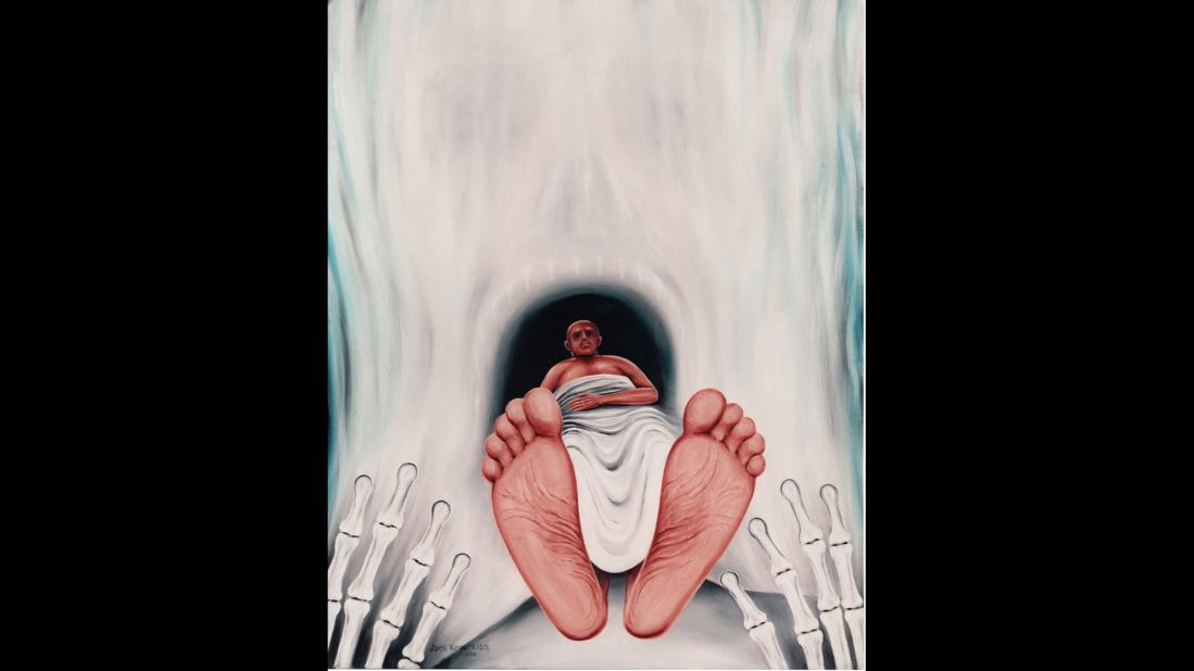"Coma" depicts an unconscious patient being pulled into the mouth of a macabre death mask which resembles the opening of a CAT scan machine, a symbol of modern medical technology. In his description of this painting, Kevorkian wrote, "How strange and inscrutable is the deep sleep of trauma or disease.  Is there consciousness in the live brain?  The eyes may be flitting, but do they see?  Does that signify dreaming?  Sometimes the sleeper awakes; but more often this last profound act of Morpheus merely provides another morsel for nature's ultimate scavenger - Death."