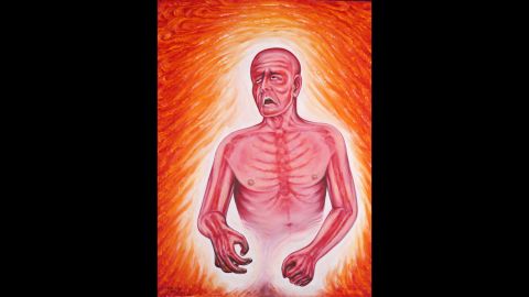 "Fever" is one of several portrayals by Kevorkian of "various medical signs and symptoms and social commentaries," according to Kevorkian. "This one depicts the great discomfort of intense bodily heat," he wrote. "The inferno is internal, and in some tragic cases even the will to live is charred."
