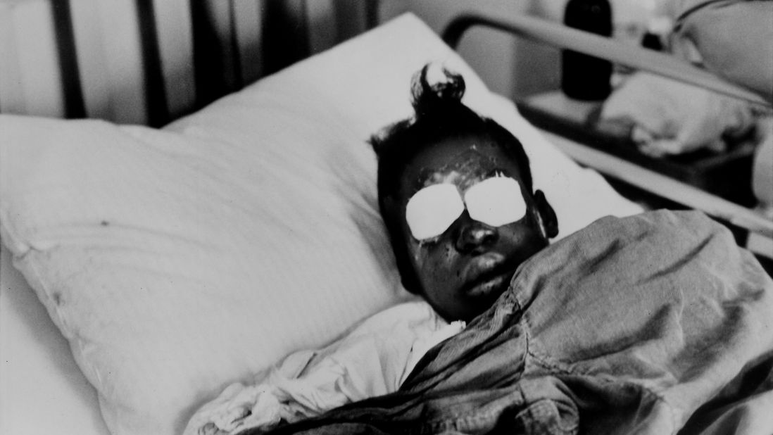 Sarah Jean Collins, 12, lies in bed after being blinded by the dynamite that killed her sister in the bombing of a Birmingham church in September 1963. Four African-American girls were killed in the blast.