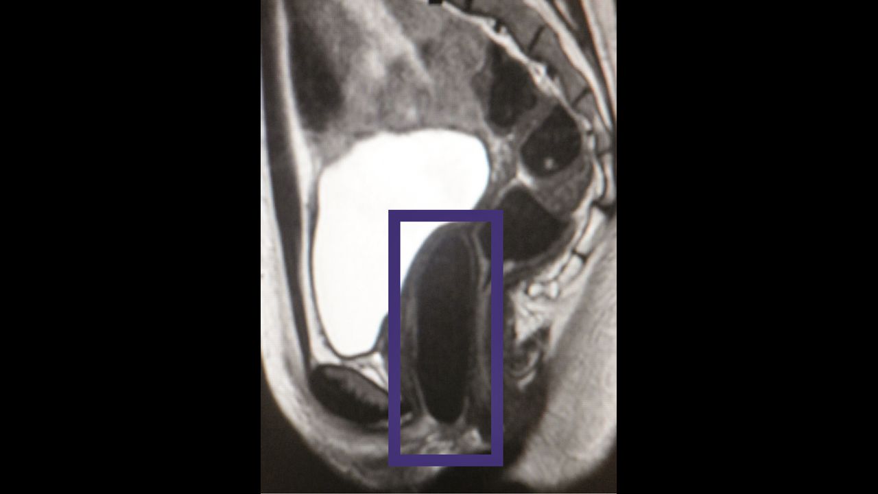 This MRI image shows the lab-engineered vaginal organ inside the patient.