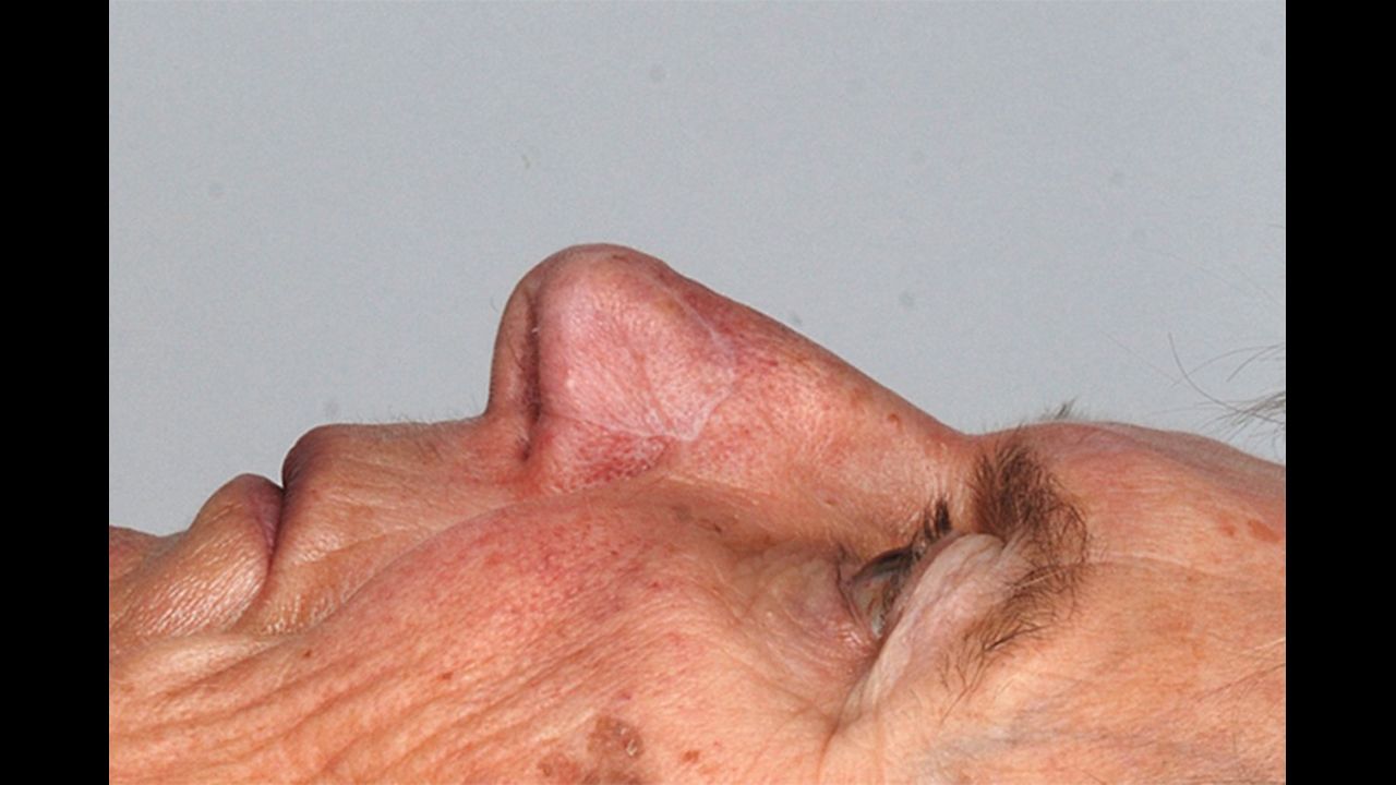 Scientists used nasal cartilage cells to rebuild the nostrils of five individuals whose noses were damaged by skin cancer. 