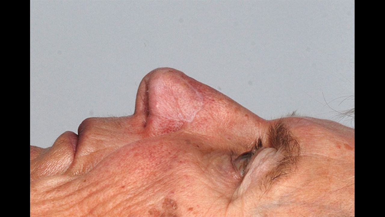 Scientists used nasal cartilage cells to rebuild the nostrils of five individuals whose noses were damaged by skin cancer.