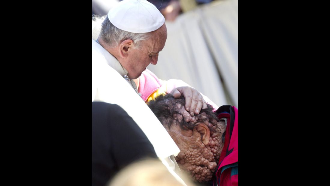Pope Francis embraced Vinicio Riva, a disfigured man who suffers from a non-infectious genetic disease, during a public audience at the Vatican in November 2013. Riva then buried his head in the Pope's chest.