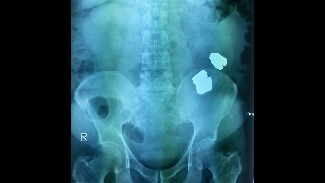 'No podíamos saber que eran barras de oro", dijo el médico. "Pero los rayos X mostraron que había un bloqueo intestinal, que requería cirugía"