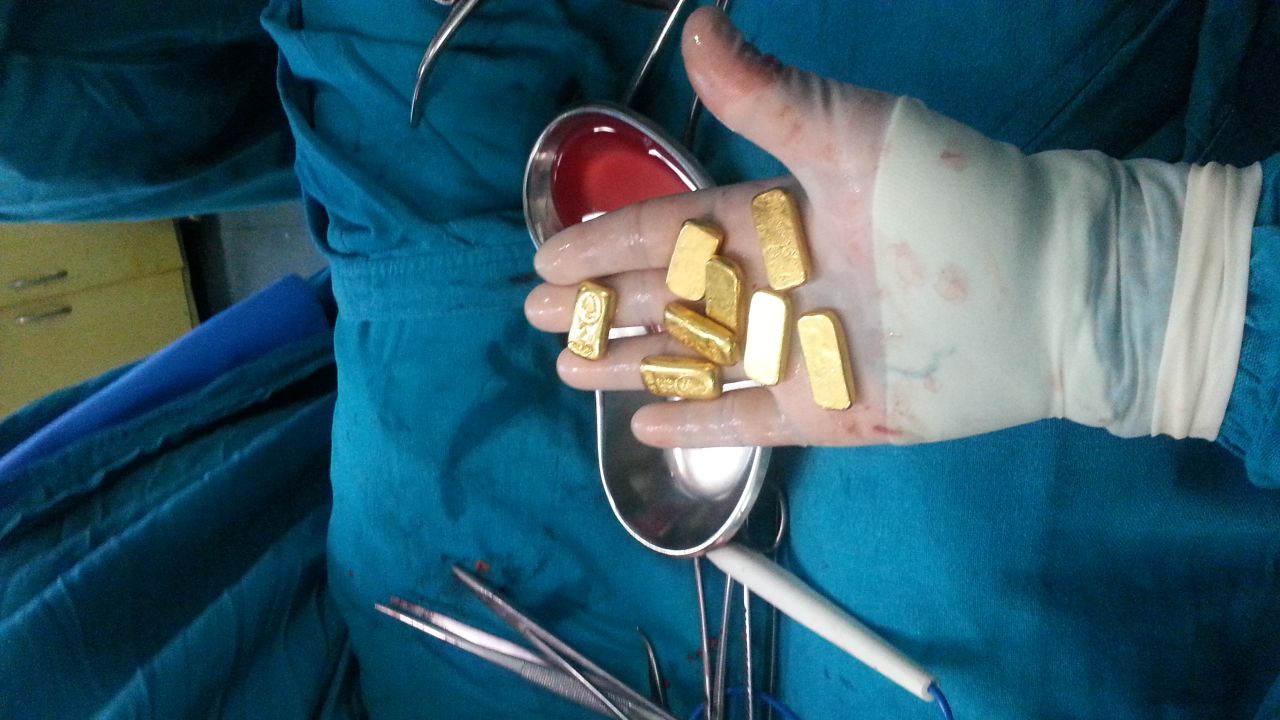 A New Delhi hospital admitted a 63-year-old man on April 8 after he complained of intestinal pain and nausea. The patient, whose name was not released, was hiding 12 gold bars in his belly. He apparently smuggled them into India to evade import duty, police and doctors said.