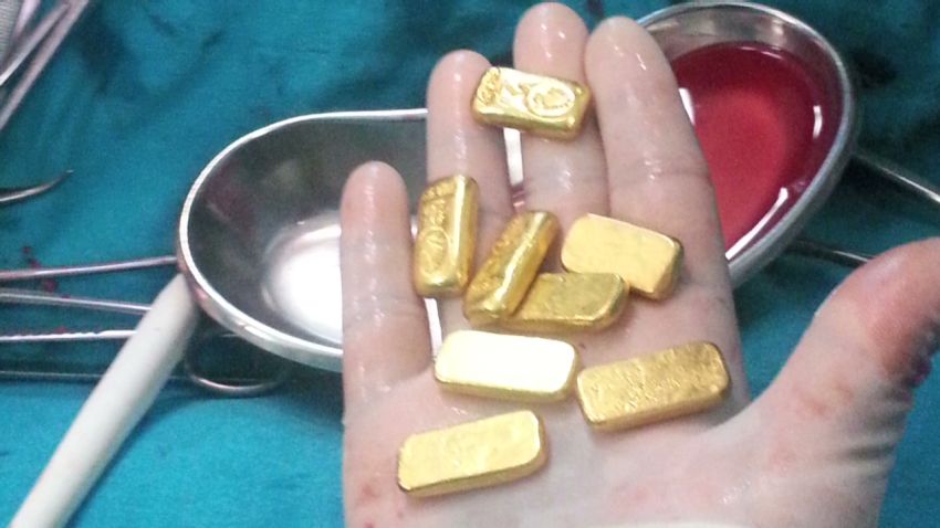 Indian surgeons extracted 12 small gold bars from a man's stomach.