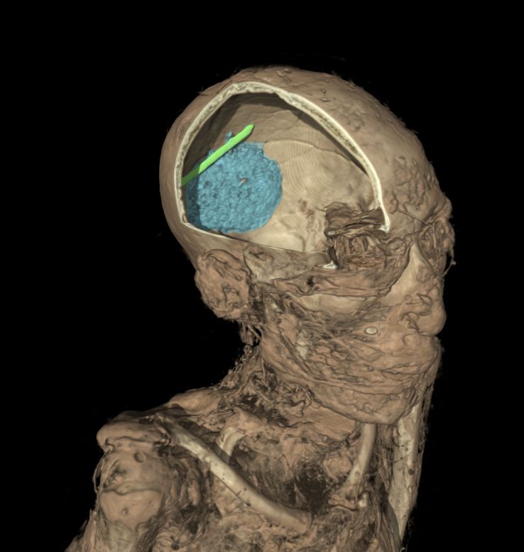 The scan also revealed that Egyptian embalmers botched the job. A chunk of his brain (in blue) was left in the skull, along with a piece of the spatula used to extract the organ (in green). 