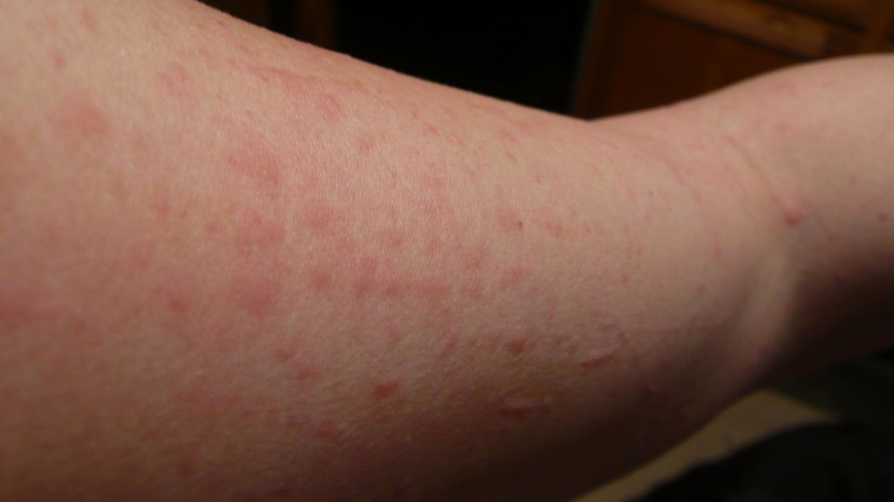 Lisa Parr broke out in rashes from the polluted air, she says.