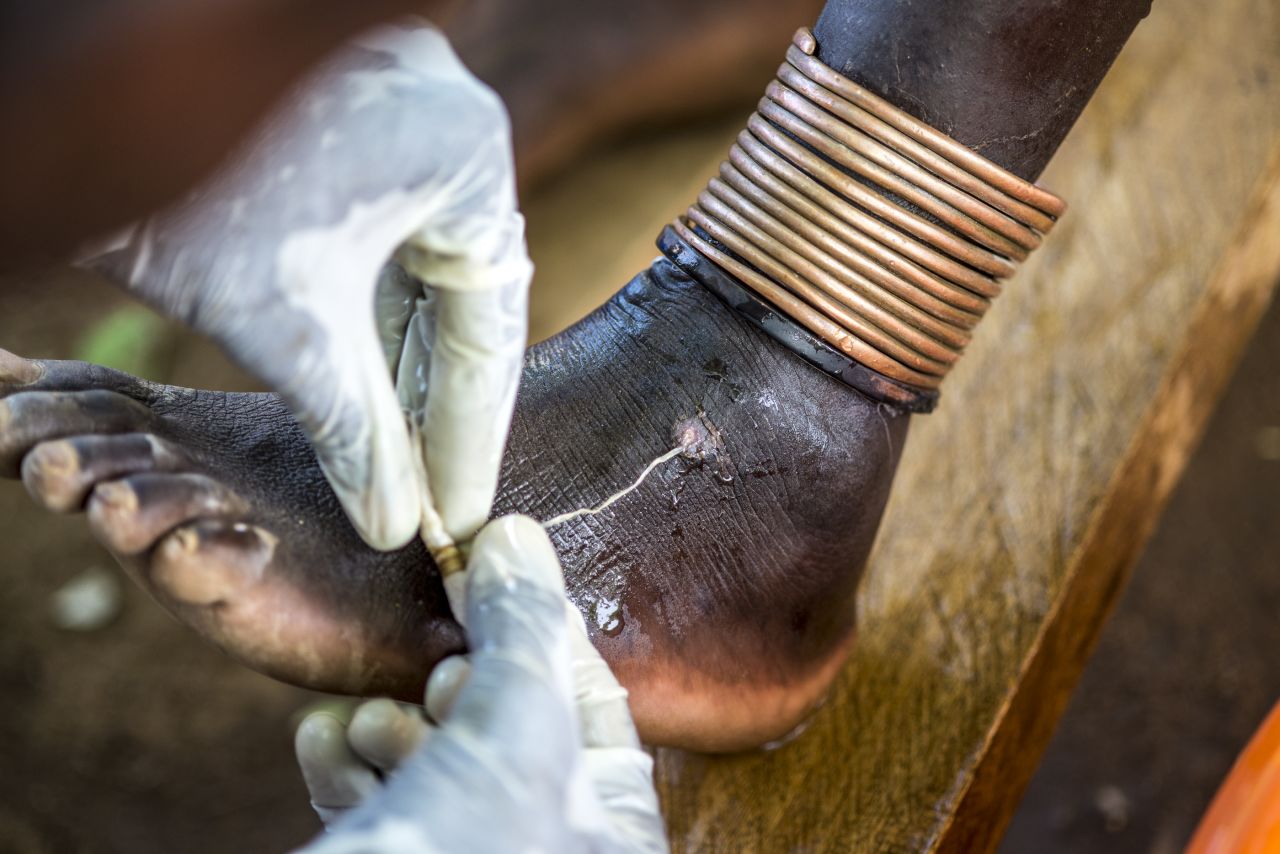 People become infected with Guinea worm after drinking water contaminated with the larvae of a parasitic worm. The larvae then grow into adult worms over the course of a year. The only treatment is to extract the worm.