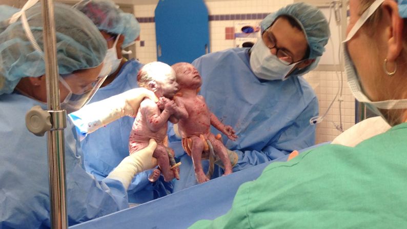 Doctors hold Jenna and Jillian Thistlewaite, twin girls born in Akron, Ohio, on Friday, May 9. The girls were <a href="http://www.hlntv.com/article/2014/05/10/identical-twins-born-holding-hands" target="_blank" target="_blank">born holding hands</a>, and they are monoamniotic or "mono mono" twins -- a pregnancy in which twins share the same placenta and amniotic sac. Researchers say "mono mono" births happen once in every 10,000 births.